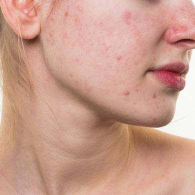 Vad är rosacea och vilka rosacea behandlingar finns det?