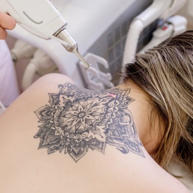 Ta bort tatuering själv hemma och metoder för tatueringsborttagning