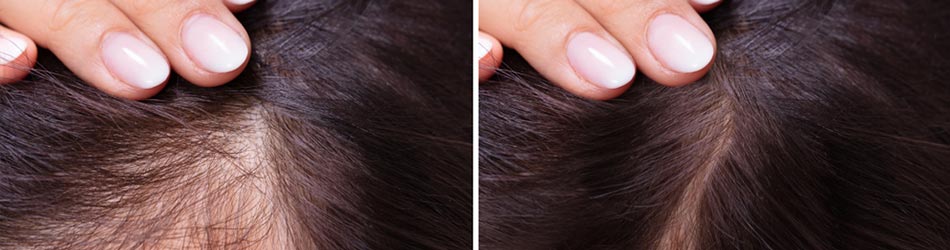 Plötsligt håravfall är normalt, men som tur är kan man få hjälp för frisk och normal hårväxt med rätt hjälpmedel.