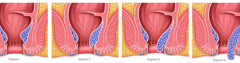 Hemorrojder definieras utifrån fyra olika stadier