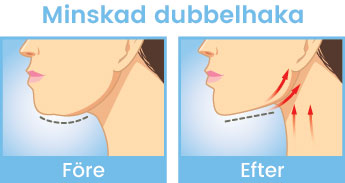 kräm mot dubbelhaka före och efter bilder kräm mot dubbelhaka före och efter bilder