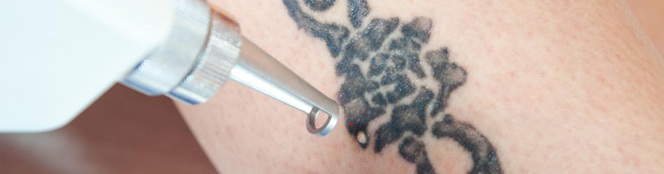 Laserborttagning av en tatuering är ett bra alternativ. Men det är ofta smärtsamt och väldigt dyrt.