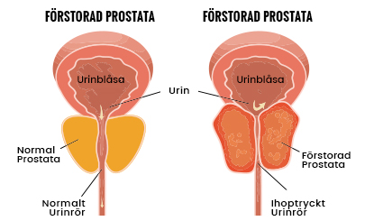 förstorad prostata genomskärning